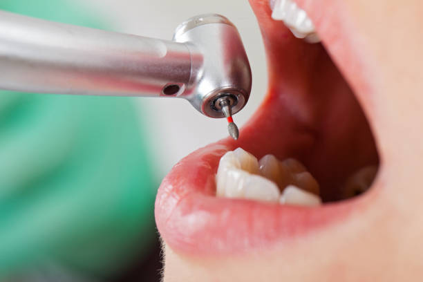 Best Emergency Dental Extractions in Massanutten, VA